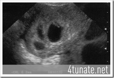 ultrasound of quadruplets image at six weeks