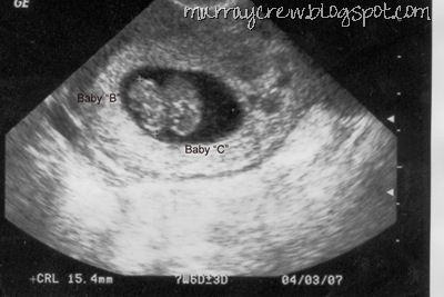 mono amniotic twins ultrasound quad pregnancy