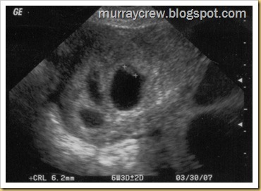 triplet pregnancy ultrasound