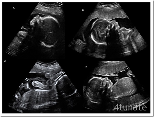 ultrasound 23 weeks quadruplets